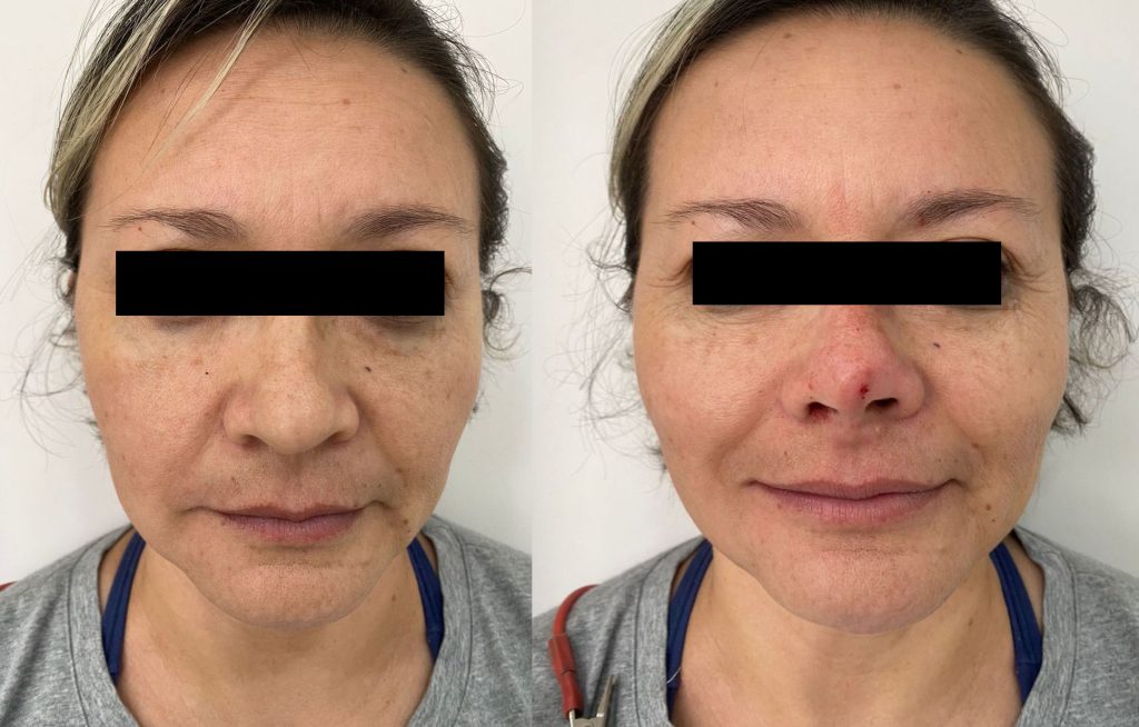 lifting facial nao cirurgico antes e depois
