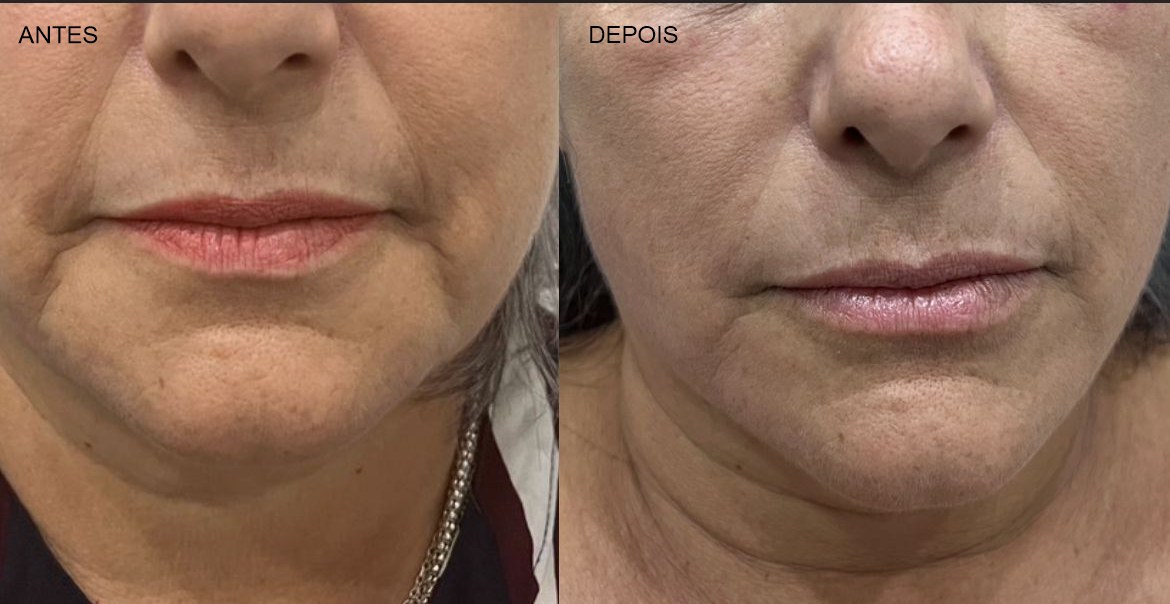 Lifting não cirúrgico antes e depois